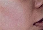 Laser Hair Removal