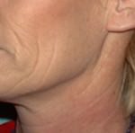 Laser Skin Resurfacing