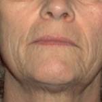 Laser Skin Resurfacing