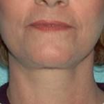 Laser Skin Resurfacing