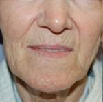 Laser Skin Resurfacing