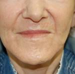 Laser Skin Resurfacing