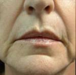 Restylane