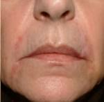 Restylane