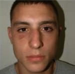 Rhinoplasty