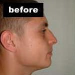 Rhinoplasty