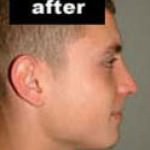 Rhinoplasty