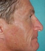 Rhinoplasty
