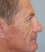 Rhinoplasty