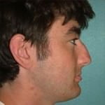 Rhinoplasty