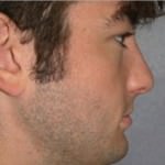 Rhinoplasty