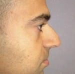 Rhinoplasty