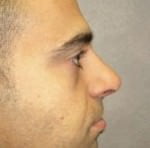 Rhinoplasty
