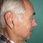 Rhinoplasty