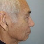 Rhinoplasty