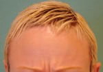 Botox
