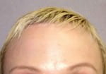 Botox