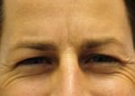 Botox