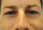 Botox