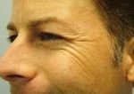 Botox