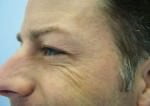 Botox