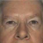 Eyelid Surgery