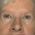 Eyelid Surgery