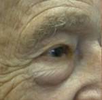 Eyelid Surgery