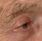 Eyelid Surgery