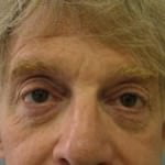 Eyelid Surgery