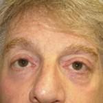 Eyelid Surgery