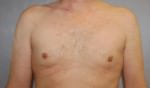 Male Breast Reduction