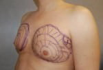 Male Breast Reduction