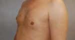 Male Breast Reduction