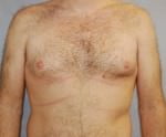 Liposuction