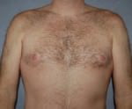 Liposuction