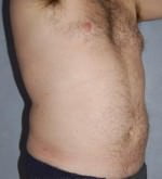 Liposuction