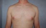 Liposuction
