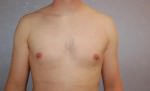 Liposuction
