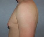 Liposuction