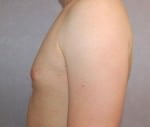 Liposuction