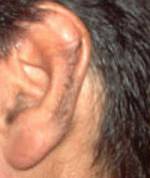 Laser Hair Removal