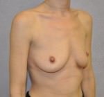 Breast Augmentation