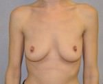Breast Augmentation