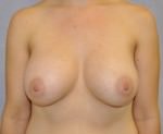 Breast Augmentation