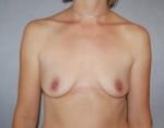 Breast Augmentation