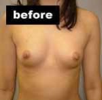Breast Augmentation