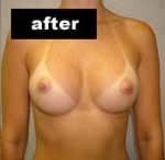 Breast Augmentation