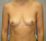Breast Augmentation