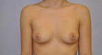 Breast Augmentation